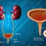 Laparoscopic-Urology-Treatment- in-Madurai